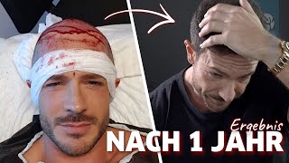 Ein Jahr nach meiner Haartransplantation  Ergebnis amp Fazit [upl. by Gustafsson126]