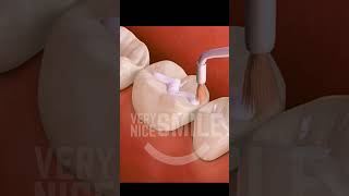 What is a Dental Sealant sealant sealants cavities nocavities dentist dentistry [upl. by Hemphill148]