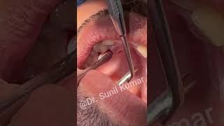 extraction of supernumerary teeth dentalextraction [upl. by Civ]