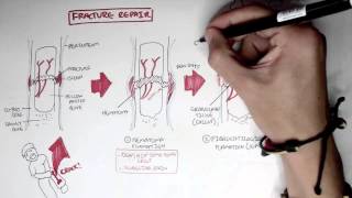 Bone Fracture  Types Fracture Repair and Osteomyelitis [upl. by Trisha]