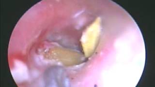 Endoscopic Foreign Body Removal from the Ear [upl. by Oiruam202]