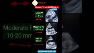 Size of Pericardial effusion in Echo echo ytshortsvideo shortsvideo [upl. by Johnathon]