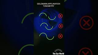 goldmann applnation tonometry [upl. by Gibert82]