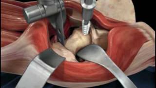 Direct Anterior Approach Hip Replacement [upl. by Kamp]