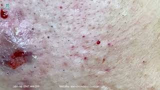 Big Cystic Acne Blackheads Extraction Blackheads amp Milia Whiteheads Removal Pimple Popping [upl. by Nimajnab]