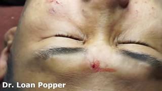 Acne Blackheads Whiteheads removals on face part 11 [upl. by Namaan]