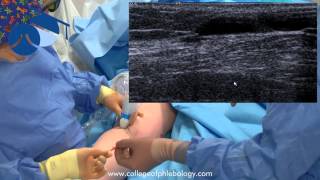 TRLOP closure of perforator veins in varicose vein surgery using NTD [upl. by Anura339]