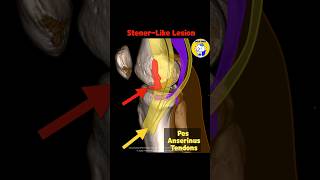 Fig 3A13 Stenerlike lesion of MCL avulsed distal MCL retracted medial to the pes tendons [upl. by Harahs]