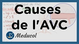 AVC causes  AVC facteurs de risque [upl. by Melvena]