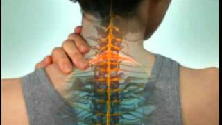 Cervical Radiculopathy  DePuy Videos [upl. by Skier]