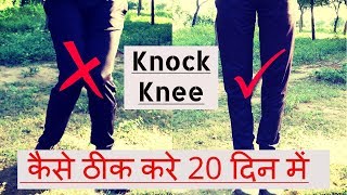 Knock Knee Kaise Thik Kare 20 Din Me Exercises  Knock Knee Problem Solution In Hindi [upl. by Las]