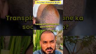 Hair Transplant Result 1 to 17 Days shortsfeed shortvideo hairtransplant myhairtransplant [upl. by Aneerbas]