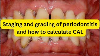 Staging and grading of periodontitis and how to measure CAL and RBL [upl. by Arjan]