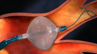 AFIB ablation using Cryoballoon Technology [upl. by Ripley]