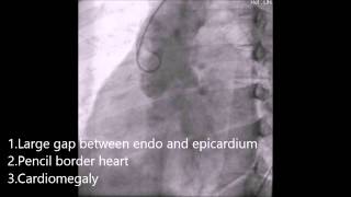 Pericardial effusion demonstration by aortic root angiogram [upl. by Dinnage]