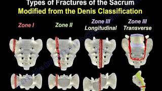 Sacral Fractures  Everything You Need To Know  Dr Nabil Ebraheim [upl. by Aicram380]