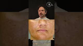 Qual o melhor tratamento para tirar as manchas do rosto Especialista dermato responde sobre melasma [upl. by Ferreby323]