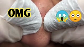 best white heads removal  closed comedones treatment  blackheads removal [upl. by Arundell]