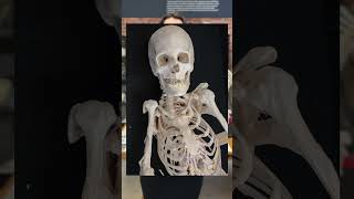 Fibrodysplasia ossificans progressiva FOP [upl. by Olwena]