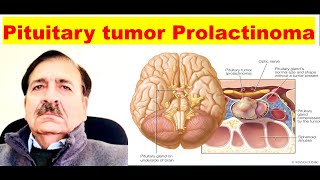 Prolactinoma Signs Symptoms diagnosis and Treatment Lectures by Dr Alamzeb [upl. by Eniawed]