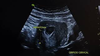 ULTRASONIDO DE 66 SEMANAS DE GESTACIÓN [upl. by Schwartz65]