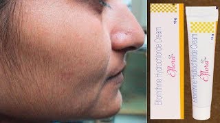 Eflora Cream for Facial Hair Removal  Eflora cream uses in Hindi [upl. by Enael941]