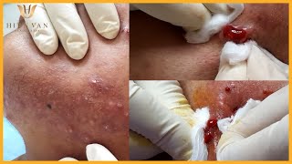 Cyst Acne I Điều trị mụn hiệu quả số 1 tại Hiền Vân Spa ITrần Quang Huy I 514 [upl. by Akinihs]