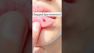 Get rid of chapped lips at home [upl. by Higinbotham]