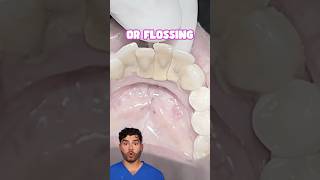 Teeth Cleaning Explained [upl. by Richlad]