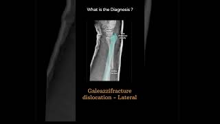 Galeazzi fracturedislocation  Lateral 127 Xray  Upper limb gallery 1 radiologychannel007 [upl. by Kowalski230]