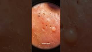 Blackheads Removal  Acne Treatment and Very Satisfying Satisfying Pimple pop blackheads [upl. by Payson]