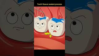 Tooth fissure sealant process [upl. by Almeda]