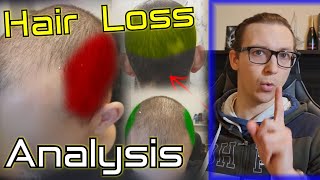 Norwood 56 Hair Loss recovery strategy Hair Transplant expectations [upl. by Elawalo632]