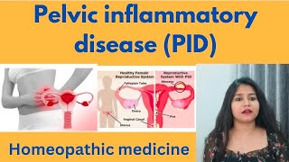 Pelvic inflammatory disease  PID treatment  PID symptomscauses amp homeopathic medicine in hindi [upl. by Rola]