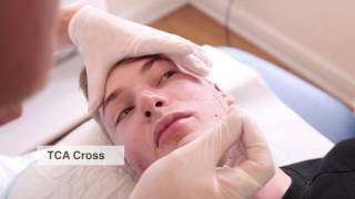 Acne scar treatment  ENGLISH subtitles available [upl. by Kielty]