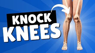 Knock Knees  Corrective Exercises and Treatment for Genu Valgum [upl. by Nafets261]