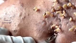 Acne amp Blackhead Treatment on his foreheadBlackhead Removal on forehead  Remove Blackhead [upl. by Attekram]