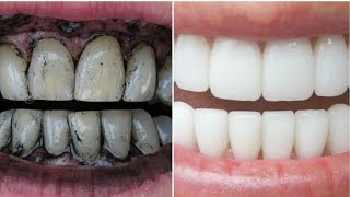 कितने भी गंदे पिले दांतों मोती सा चमकदार बनाना देता है ये फ्री का उपाय  teeth whitening [upl. by Anelac]