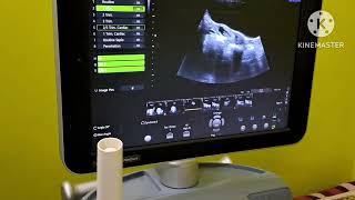 Live Ectopic pregnancy  Right Ovarian [upl. by Hannon]