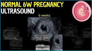 Early Glimpse 6Week Pregnancy Ultrasound Revealed [upl. by Pachton]