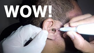 Mans Earwax Buildup Removal with Hydrogen Peroxide Application [upl. by Leodora]