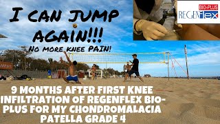 Chondromalacia Patella Grade 4  REGENFLEX BIOPLUS [upl. by Dinah]