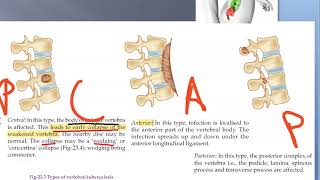 Orthopedics Potts spine Paraplegia Tuberculosis of Bone Tuberculous Osteomyelitis Minerva Jacket [upl. by Ittam]