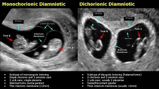 Fetal Twins Ultrasound Normal Vs Abnormal  MonochorionicDichorionicDiamnioticMonoamniotic USG [upl. by Eidaj]