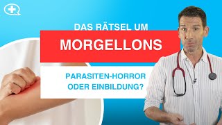 Morgellons Einbildung Verschwörung oder echte Krankheit [upl. by Anairam]