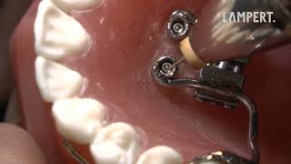 PUK Welding  palatal implants [upl. by Omsoc]