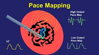 Pace Mapping Principles and Pitfalls [upl. by Adirf238]