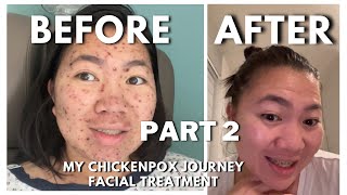 Chickenpox Symptoms  Treatment  facial skin care routine [upl. by Ellehcram]