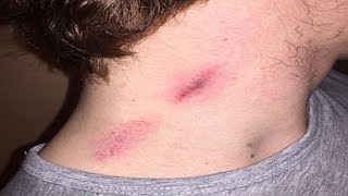 How To Make Hickies Go Away  10 Fastest Way To Get Rid Hickies Quickly [upl. by Hadias]