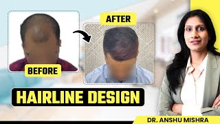 Hairline Design for Hair Transplant  How to set Hairline for Transplant  Dr Anshu Mishra Dubai [upl. by Gelman]